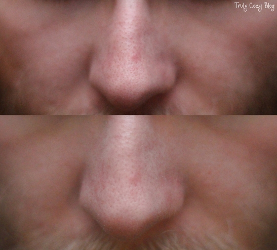 BlackheadRemoval-A-Before-After